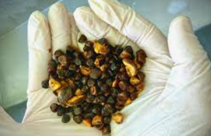 Bovine gallstones held in a gloved hand
